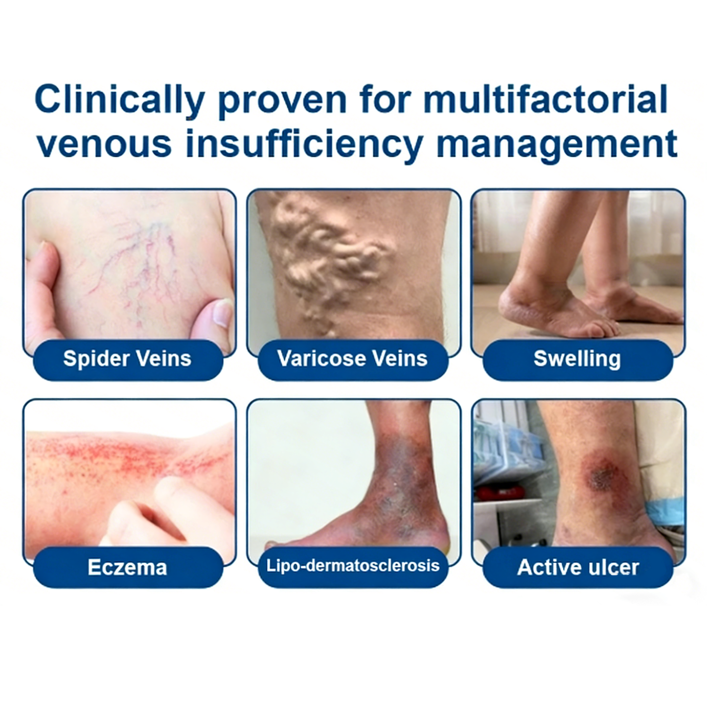 KLENIMORE® 𝑽𝗲𝗶𝙣 𝘾𝐨𝐧𝘁𝗼𝙪𝙧 𝙈𝙞𝐜𝐫𝒐𝒏𝒆𝗲𝗱𝗹𝙚 𝙋𝙖𝐭𝐜𝒉 𝒘𝒊𝘁𝗵 𝗔𝙙𝙫𝙖𝙣𝙘𝐞𝐝 𝐃𝒊𝒐𝒔𝗺𝙞𝐧 & 𝑯𝒆𝘀𝗽𝗲𝙧𝙞𝙙𝙞𝐧 𝐃𝒆𝒍𝒊𝒗𝗲𝗿𝙮🌿𝟕-𝐃𝐚𝐲 𝐕𝐢𝐬𝐢𝐛𝐥𝐞 𝐑𝐞𝐬𝐮𝐥𝐭𝐬 𝐟𝐨𝐫 𝐕𝐚𝐫𝐢𝐜𝐨𝐬𝐞 𝐕𝐞𝐢𝐧𝐬